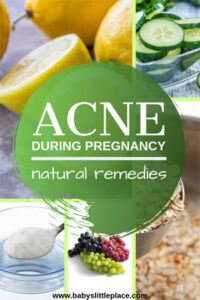 Best Pregnancy Acne Treatments [ Natural Remedies ]